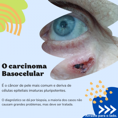 Dezembro Laranja: O que é o Carcinoma Basocelular. 